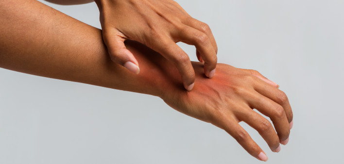 Woman scratching her hand, suffering from psoriasis