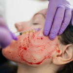 woman gets Revolutionary treatment of rejuvenation with blood plasma vampire facial