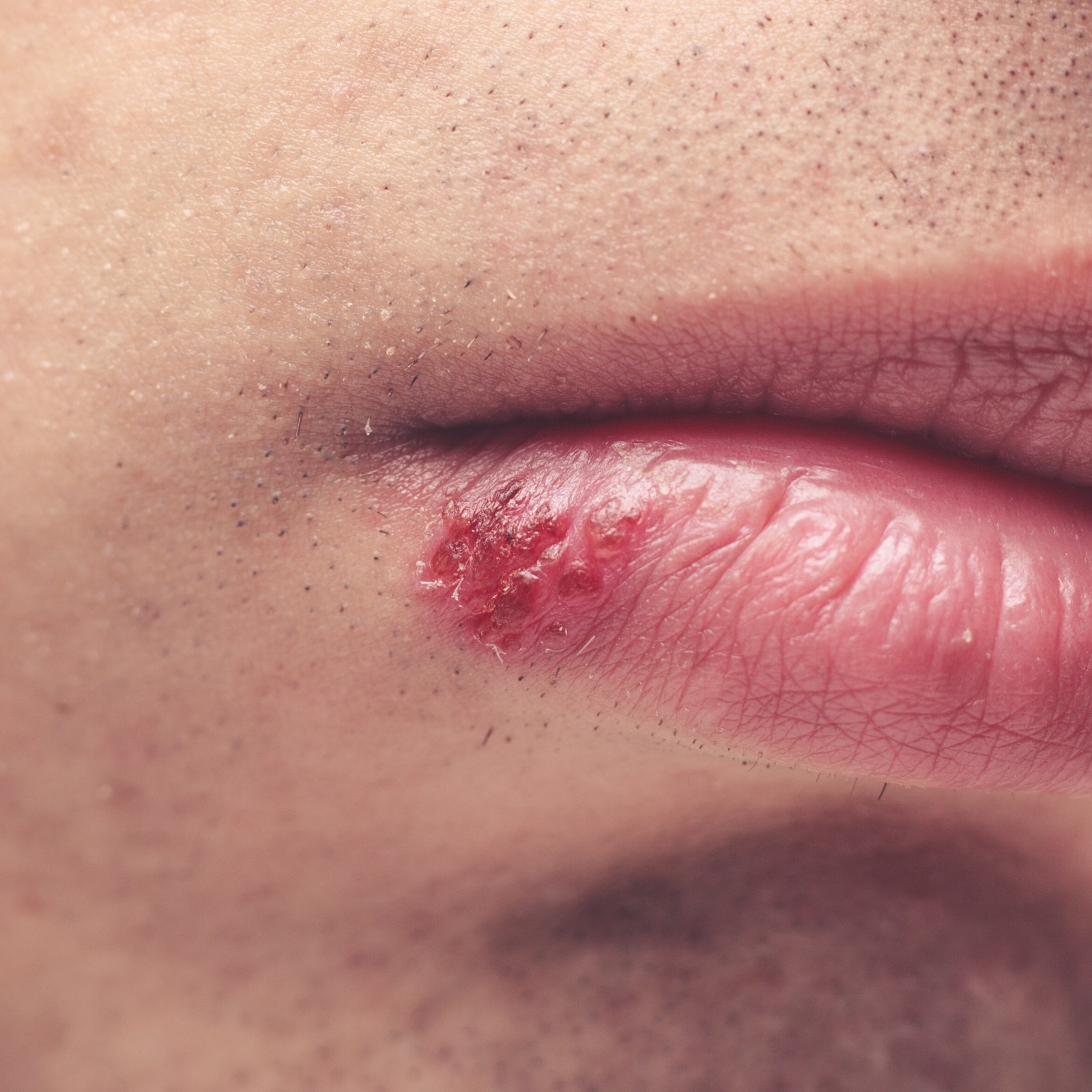 23459 Herpes IStock 487997117  19fc9ca8 7ed8 4a75 9e51 A0e46e6299d4 X2 