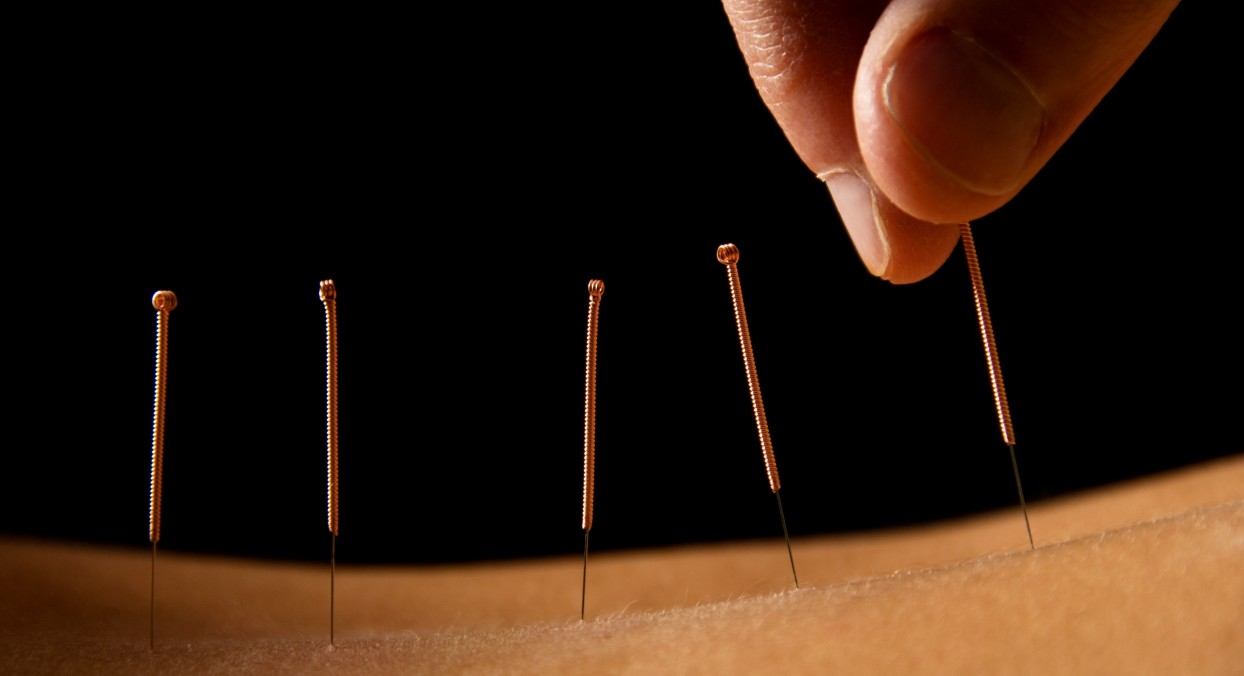 Acupuncture Relieves Joint Pain Caused by Hormone Therapy Cancer Health