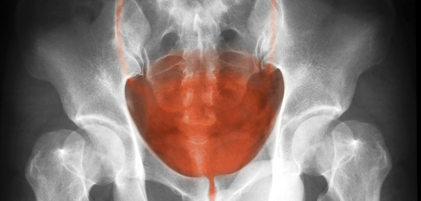 FDA Approves First FGFR Inhibitor for People with Advanced ...